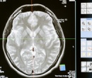 8 de junio: Día Internacional de los Tumores Cerebrales