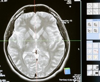 8 de junio: Día Internacional de los Tumores Cerebrales